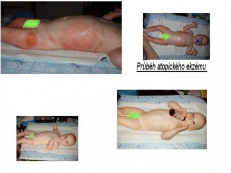 Po 2 měsících byl ekzém pryč!